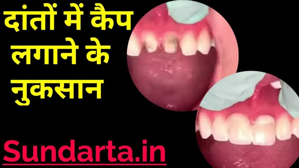 दांतों में कैप लगाने के नुकसान -