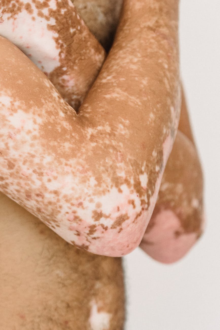 crop anonymous man with vitiligo crossing arms on naked chest