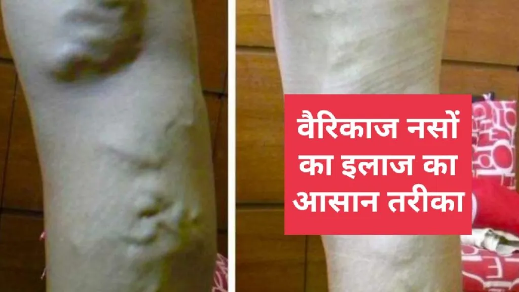 घर पर वैरिकाज़ नसों का इलाज करने का आसान तरीका