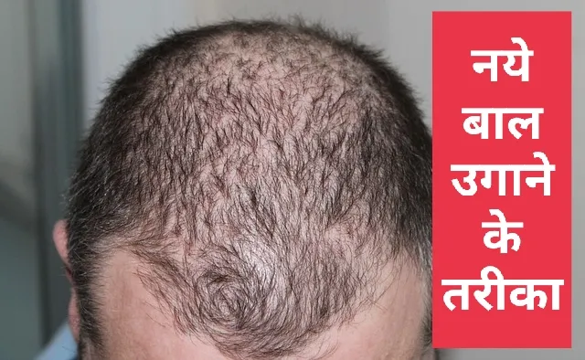 नये बाल उगाने का तरीका - देखते ही देखते बाल आने होंगे शुरू